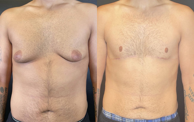 MaDan-Before-After-Gynecomastia MaDan-Before-After-Gynecomastia