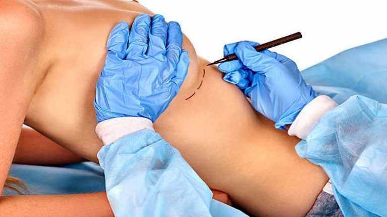 San Francisco Breast Reduction 768x432